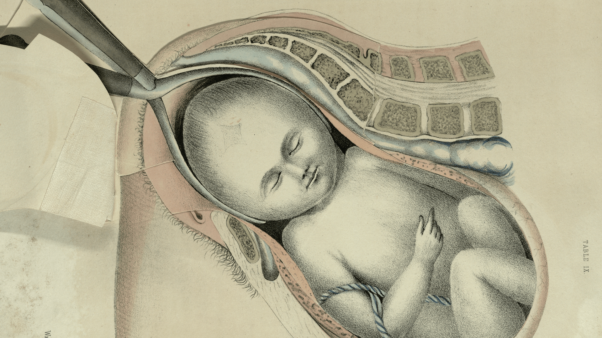Anatomical illustration of a baby being pulled from its mother with forceps
