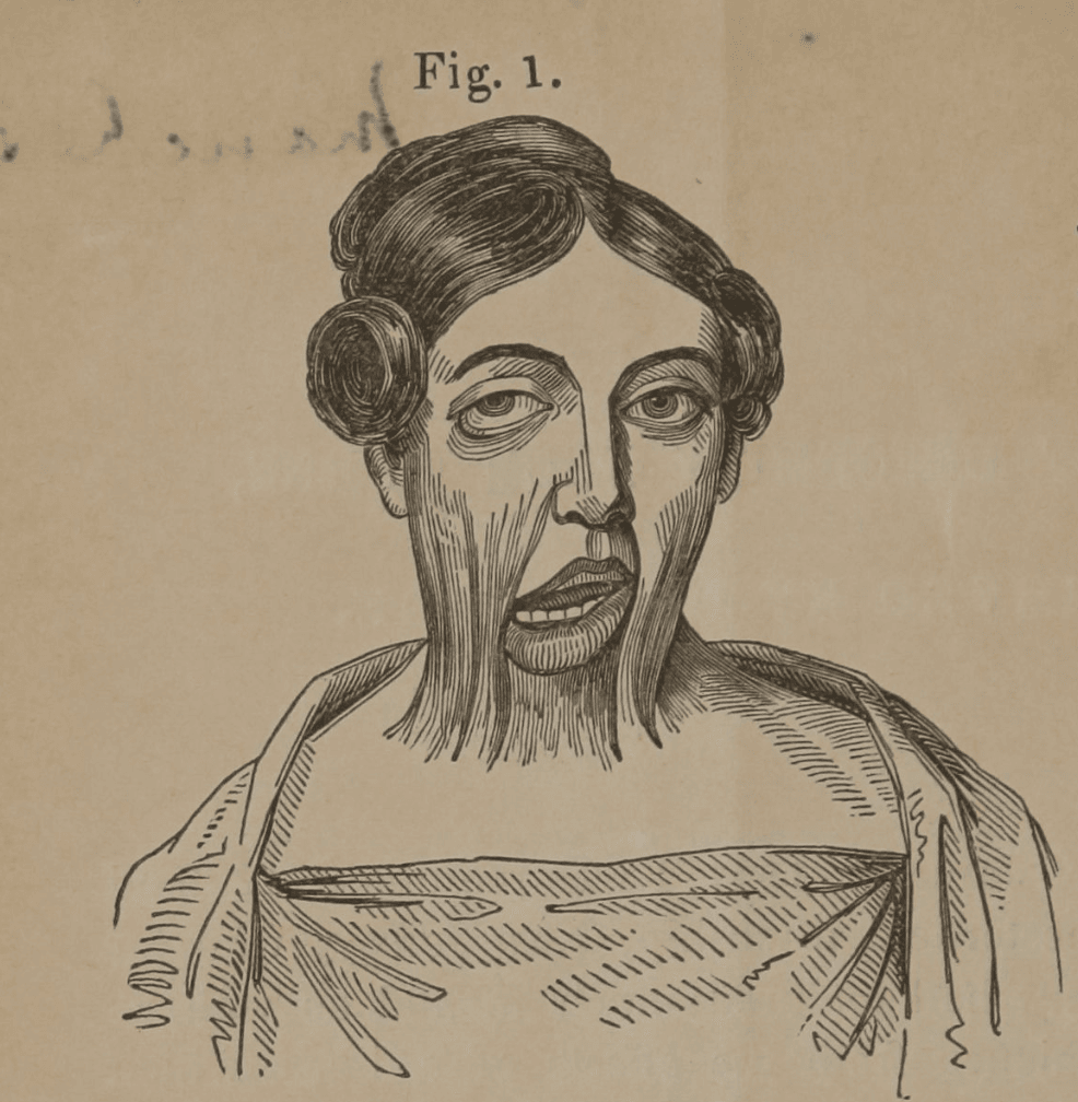 Illustration of woman with hair pinned up and with significant deformity to the skin of her neck and face