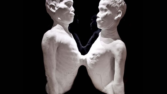 Death cast of twins Chang and Eng Bunker conjoined at the torso